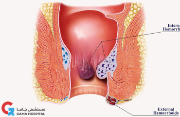 What are Hemorrhoids?