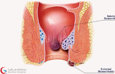 What are Hemorrhoids?